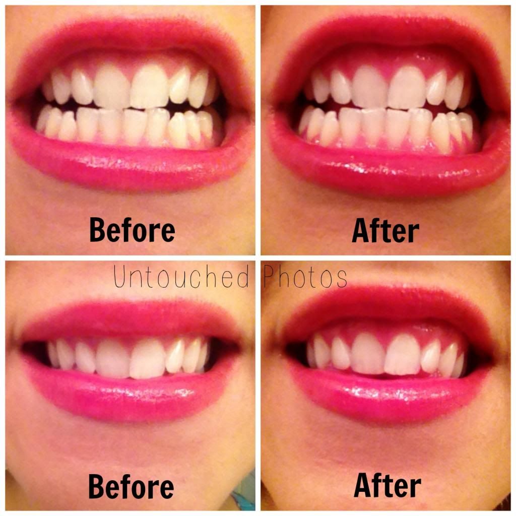 brilliant-tooth-whitening-kit-reviews